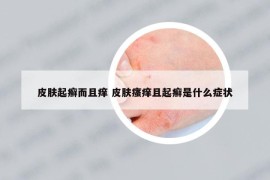 皮肤起癣而且痒 皮肤瘙痒且起癣是什么症状