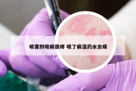 喷雾剂喷癣很疼 喷了癣湿药水会痒