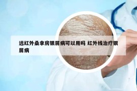 远红外桑拿房银屑病可以用吗 红外线治疗银屑病