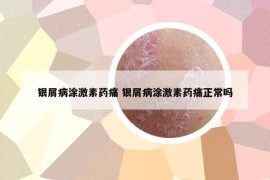 银屑病涂激素药痛 银屑病涂激素药痛正常吗