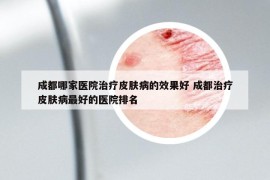 成都哪家医院治疗皮肤病的效果好 成都治疗皮肤病最好的医院排名