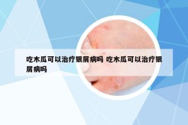 吃木瓜可以治疗银屑病吗 吃木瓜可以治疗银屑病吗