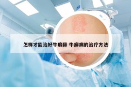 怎样才能治好牛癖藓 牛癣病的治疗方法