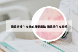 狼毒治疗牛皮癣的用量用法 狼毒治牛皮廨吗