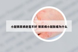 小腿银屑病老是不好 银屑病小腿胀痛为什么