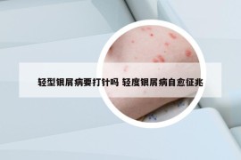 轻型银屑病要打针吗 轻度银屑病自愈征兆