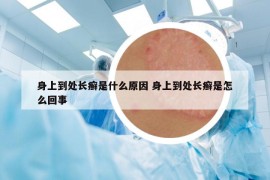 身上到处长癣是什么原因 身上到处长癣是怎么回事