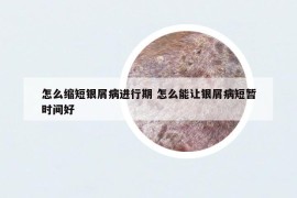 怎么缩短银屑病进行期 怎么能让银屑病短暂时间好