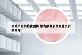 银关节炎的症状图片 银宵病关节炎用什么药效果好