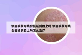 银屑病发际线会蔓延到脸上吗 银屑病发际线会蔓延到脸上吗怎么治疗