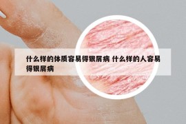 什么样的体质容易得银屑病 什么样的人容易得银屑病