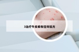 3治疗牛皮癣有佳效验方