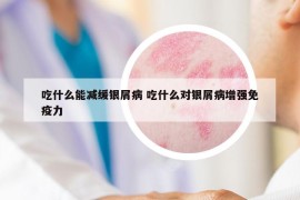 吃什么能减缓银屑病 吃什么对银屑病增强免疫力