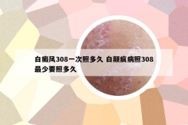 白癜风308一次照多久 白颠疯病照308最少要照多久