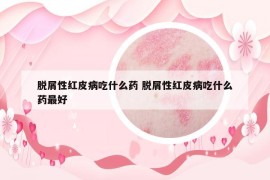 脱屑性红皮病吃什么药 脱屑性红皮病吃什么药最好