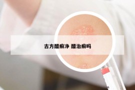 古方醋癣净 醋治癣吗