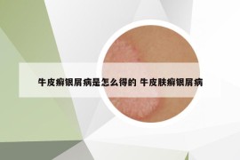 牛皮癣银屑病是怎么得的 牛皮肤癣银屑病