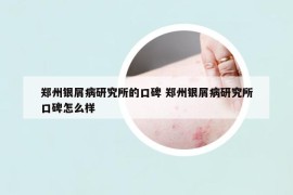 郑州银屑病研究所的口碑 郑州银屑病研究所口碑怎么样