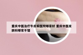 重庆中医治疗牛皮癣医院哪家好 重庆中医皮肤科哪家不错