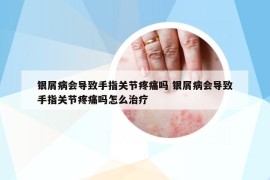 银屑病会导致手指关节疼痛吗 银屑病会导致手指关节疼痛吗怎么治疗