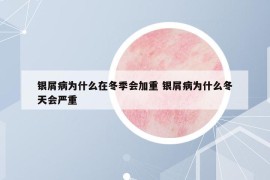 银屑病为什么在冬季会加重 银屑病为什么冬天会严重