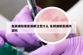 鱼鳞病和银屑病要注意什么 鱼鳞病银屑病传染吗