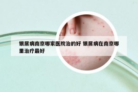 银屑病南京哪家医院治的好 银屑病在南京哪里治疗最好