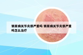 银屑病关节炎很严重吗 银屑病关节炎很严重吗怎么治疗