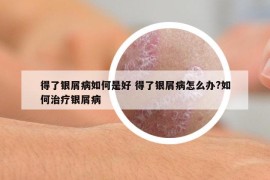 得了银屑病如何是好 得了银屑病怎么办?如何治疗银屑病