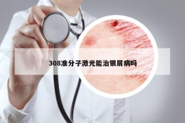 308准分子激光能治银屑病吗