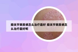 膝关节银屑病怎么治疗最好 膝关节银屑病怎么治疗最好呢