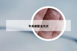 牛皮癣整治方式