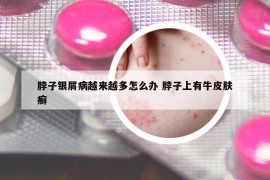 脖子银屑病越来越多怎么办 脖子上有牛皮肤癣