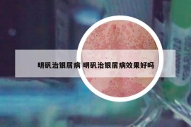 明矾治银屑病 明矾治银屑病效果好吗