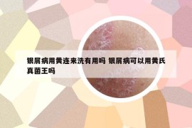 银屑病用黄连来洗有用吗 银屑病可以用黄氏真菌王吗