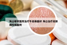 海口哪家医院治疗牛皮癣最好 海口治疗皮肤病权威医院