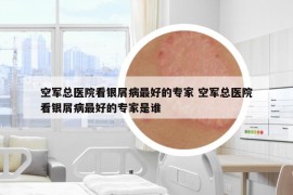 空军总医院看银屑病最好的专家 空军总医院看银屑病最好的专家是谁