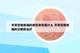 寻常型银屑病的典型表现是什么 寻常型银屑病的诊断和治疗