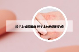 脖子上长圆形癣 脖子上长椭圆形的癣