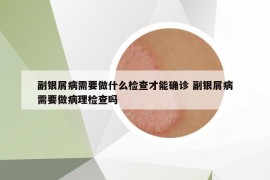 副银屑病需要做什么检查才能确诊 副银屑病需要做病理检查吗