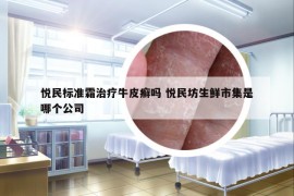 悦民标准霜治疗牛皮癣吗 悦民坊生鲜市集是哪个公司