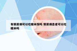 有银屑病可以吃糯米饭吗 银屑病患者可以吃糯米吗