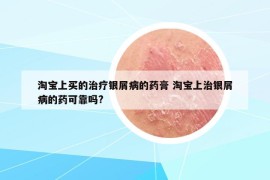 淘宝上买的治疗银屑病的药膏 淘宝上治银屑病的药可靠吗?