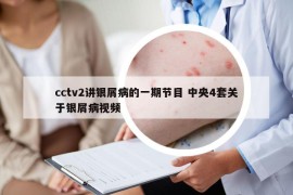 cctv2讲银屑病的一期节目 中央4套关于银屑病视频