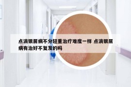 点滴银屑病不分轻重治疗难度一样 点滴银屑病有治好不复发的吗