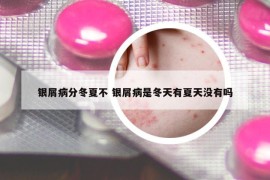 银屑病分冬夏不 银屑病是冬天有夏天没有吗