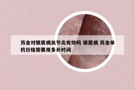 苏金对银屑病关节炎有效吗 银屑病 苏金单抗价格需要用多长时间