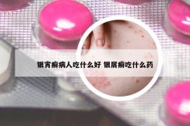 银宵癣病人吃什么好 银屑癣吃什么药