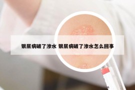 银屑病破了渗水 银屑病破了渗水怎么回事