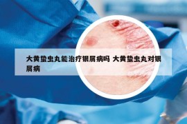 大黄蛰虫丸能治疗银屑病吗 大黄蛰虫丸对银屑病